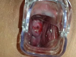 AnnaCoprofield – Through The Speculum screenshot 1
